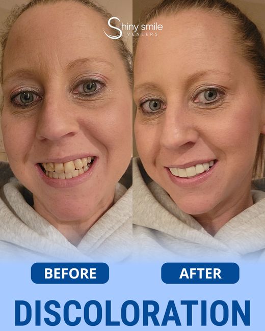 Discoloration quietly aging you?